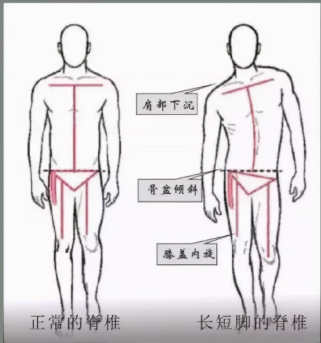 您所關心的正是我們關注的---兒童青少年脊柱側彎(圖2)